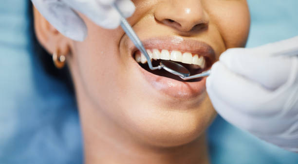Best Chipped Tooth Repair Near Me  in Fairwood, WA